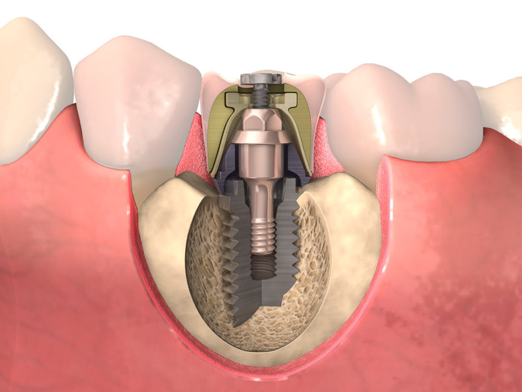 Procedimiento implantes dentales
